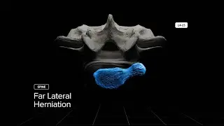 Voyage Into Kambin’s Prism - Far Lateral Herniation