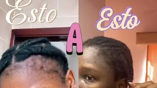 Como hice crecer mi cabello de las frente 