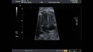 TOSHIBA APLIO-80 (2003) APICAL 4 CHAMBER VIEW #(FETAL ECHOCARDİOGRAPHY)