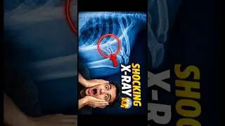 Ignore Mat Karo! Shoulder X-Ray Shocking Result