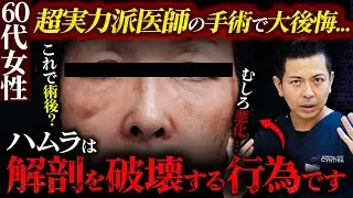 【60代女性】超実力派医師によるハムラで目の下がむしろ悪化！？クマ治療における