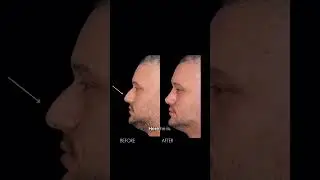 Rhinoplasty: 1 Month Post-Op | Dr. Paul E. Chasan
