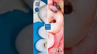 Лечение кариеса 25, 26. Стоматология Soft Smile на Цветном бульваре #кариес