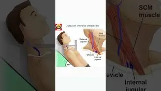 JVP measurement location and angle of patient position