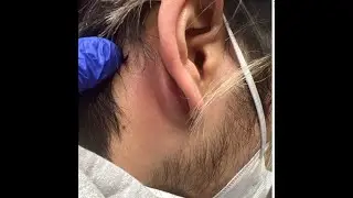 Mastoiditis vs. Posterior Auricular Abscess and/or Epidermoid Cyst?