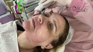 Revitalização para prevenir intercorrências pós jato de plasma
