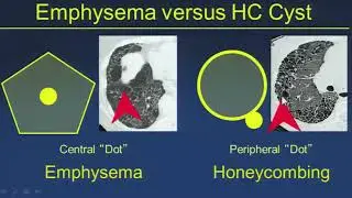 Diagnosing UIP/IPF: Pearls & Pitfalls-- H. Page McAdams, MD (SCBT-MR/SABI 37th Annual Course)