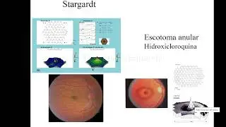 ERG multifocal y por pattern