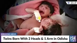 Twins Born With 2 Heads & 1 Arm in Odisha