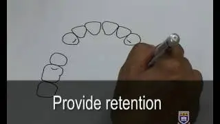 Designing an Upper Metal Partial Denture Kennedy Class III