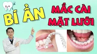 Mắc Cài Mặt Lưỡi | Niềng Răng Mắc Cài Mặt Lưỡi | Niềng Răng | Nam Bùi Vinalign
