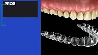 What Should You Choose Permanent or Removable Retainer?