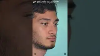 Persian Rhinoplasty Male Patient Before & After