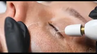Plasma Fibroblast Training at Eye Design Academy