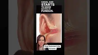 How to treat #swimmersear at home! DIY #homeremedy for Otitis Externa