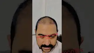 Hair transplant 3 months result #hairtransplant #hair #hairgrowth #foryou