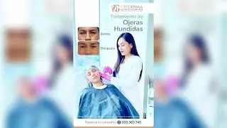 🥺&iquest;Tienes ojeras hundidas y quieres lucir una mirada rejuvenecida?👁️👁️- Dra. Gisela Pilar Aire Farf&aacute;n