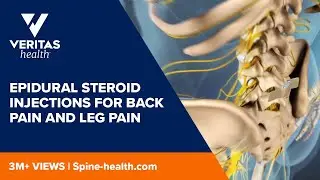 Epidural Steroid Injections for Back Pain and Leg Pain