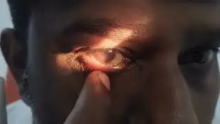 Vasanth Jebaraj, Clinical Practical, Fellowship Contact Lens, NCVRT Batch 12 January 2025