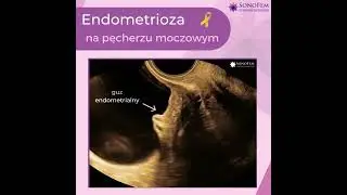 Endometrioza na pęcherzu moczowym