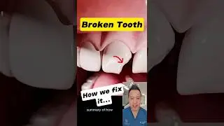 Broken Front Tooth? Here&rsquo;s How Dentists Restore Your Smile! #dentallan #dentist #shorts
