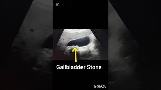 Ultrasound showing Gallbladder Stone!Cholelithiasis!#ultrasoundmadeeasy86#radiology