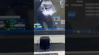 CRL & FHR in 9 weeks pregnancy ultrasound #crl #fhr #ultrasound #obs #gyne