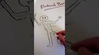 Electrical Burn Damage From inside Out #emt #science #electrical #emergency #ems #emtb #baja