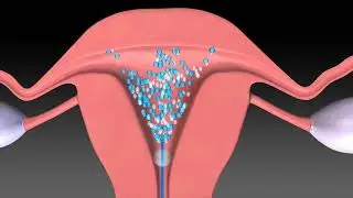 The FemVue Procedure
