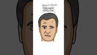 Bell's Palsy