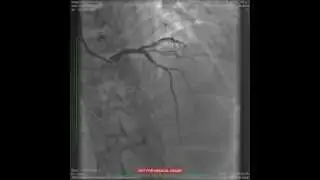 Trans Radial PCI 1
