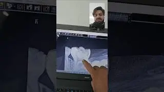 Pulpectomy -  Kiya Dhoodh Ka Dant Nekalwa Dy #dentist #asmr #Pulpectomy #babyteeth