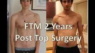 FTM 2 years post top surgery
