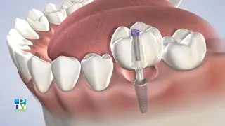 Dental Implant Candidacy in King County WA:Dr. Carl |Pacific Northwest Oral & Maxillofacial Surgeons