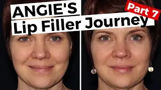 Angie's Lip Filler Journey-Part 7 |Perfect Lips | David Bushore, M.D. | Austin, TX | Ph:512-459-4869