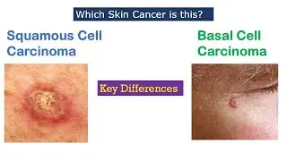 Skin Cancer! Squamous Cell Carcinoma vs Basal Cell Carcinoma | How to differentiate Clinically?