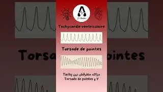 #astuces⚡️#ECG 🫀diff&eacute;rencier entre tachycardie ventriculaire et torsade de pointes #semio 🩺#cardio
