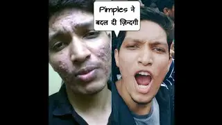 how to acne remove,how to acne scars remove,how to acne marks remove,#SHORT