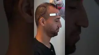 ✨Behind every natural-looking hair transplant lies a precise scientific approach.💇&zwj;♂️