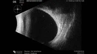 20 MHz Annular Ophthalmic Ultrasound ABSolu, Mild medial rectus swelling , 36930
