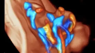 True knot 🪢 umblical cord fetal ultrasound