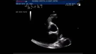 Pericardial effusion #echocardiography #echo #heartmonitoring #cardiology @SafaMedicalLecture