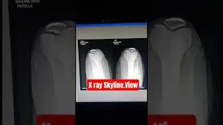 X RAY SKYLINE . VIEW Position radiology #@health.point#