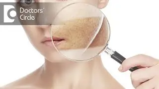 Natural ways to manage pigmentation due to hormonal imbalance in girls - Dr. Rashmi Ravindra