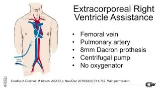 SwissCardio - Acute ischemic right HF in A dissection