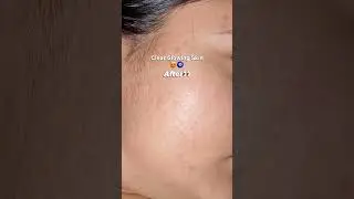 Acne free clear skin with neem basil face wash concentrate | Anti acne face wash | Clean clear skin
