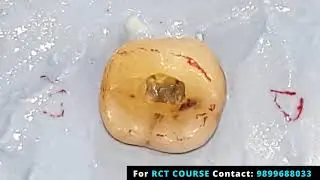 Endo Access Preparation - Mandibular First Molar- Live Demo General Dentistry Course- Root Canal