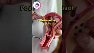 Spotting or Bleeding After Menopause? Why Immediate Evaluation Is Needed | Dr. Mansha Grover