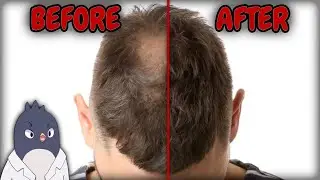Special Vitamin E Helps Regrow 34% More Hair?