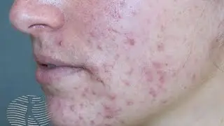 Acne Scars Removal Treatments | KAYAKALP LASER CLINIC